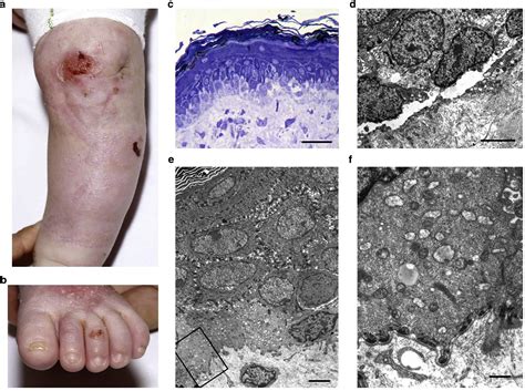 Mutations In Klhl24 Add To The Molecular Heterogeneity Of Epidermolysis