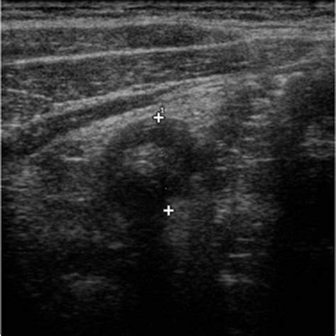 Ultrasound features of hypertrophic pyloric stenosis. On the cross ...