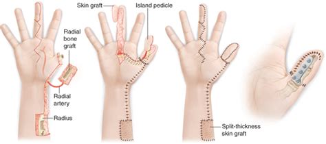 Ring Or Middle Finger Neurovascular Island Flaps For Thumb Reconstruction Musculoskeletal Key