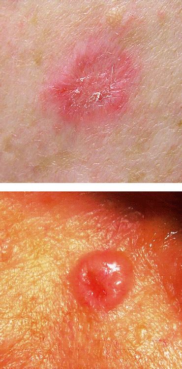 BCC (Basal Cell Carcinoma)