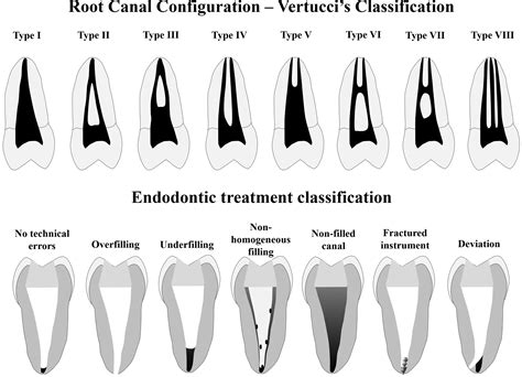 Association Between The Root Canal Configuration Endodontic Treatment Technical Errors And