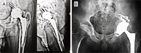 A Preoperative X Ray For A Loose Cemented Cup And Muller Ring From An Download Scientific