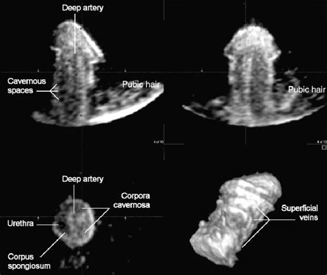 Figure 2 From Real Time Three Dimensional Ultrasound Visualization Of