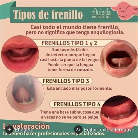 Tipos De Frenillo Tipos De Frenillos Infografia Frenillo