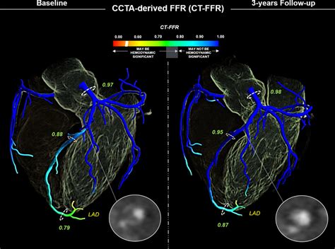 High Risk Plaque Regression And Stabilization Circulation