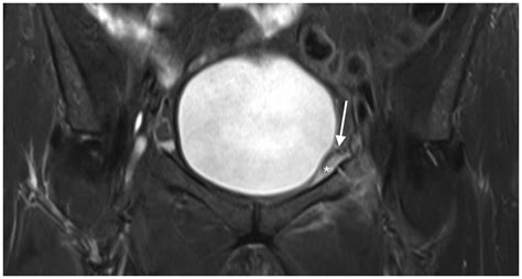 Pectineal Ligament