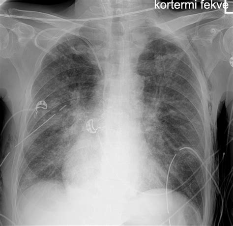 Chest Tube Placement X Ray