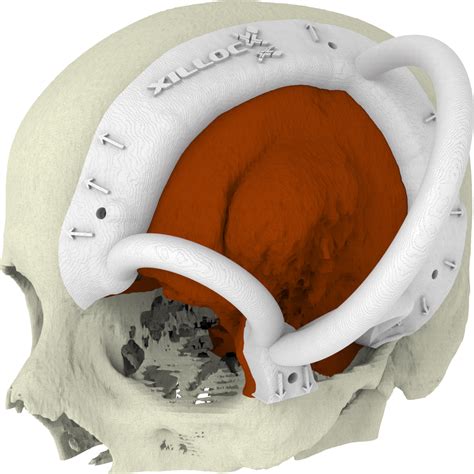 Single step meningioma resection and reconstruction using 3D Printing | Xilloc