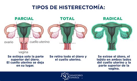 Fibromatosis Uterina Dra Ana Teresa Serrao