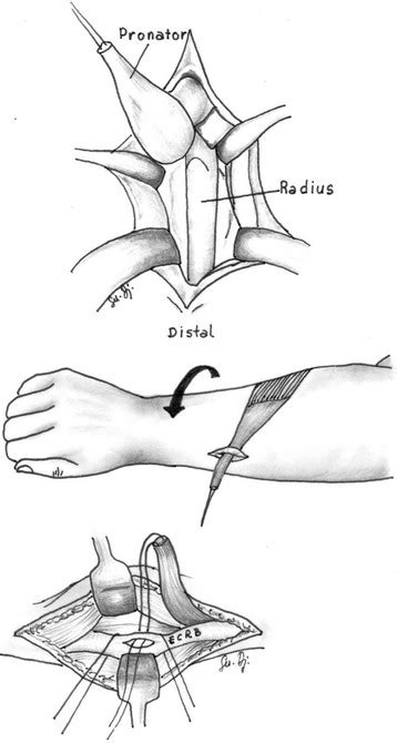 A Schematic Of A Pronator Teres To Extensor Carpi Radialis Brevis Download Scientific Diagram