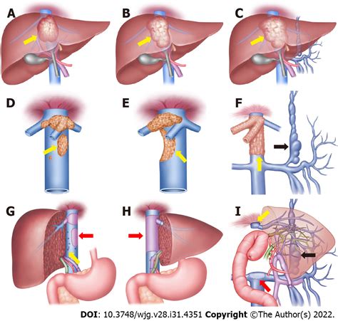 Hepatic Vein Inferior Vena Cava