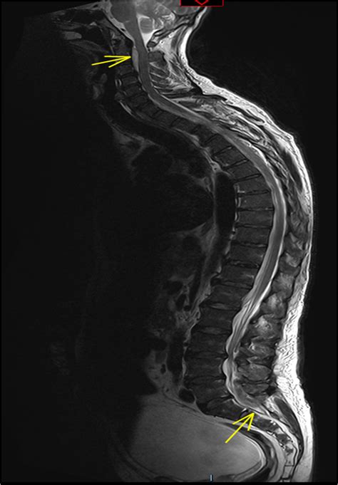 Figure 1 Sagittal Section Showing Epidural Abscess From S2 Through The