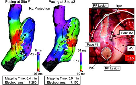 Rapid High Resolution Electroanatomical Mapping Circulation