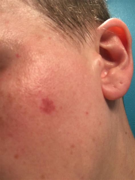 [skin Concerns] Did I Chemical Burn My Face With Vitamin C R Skincareaddiction