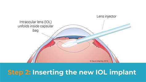 Cataract Surgery A Guide For Patients London Cataract Centre