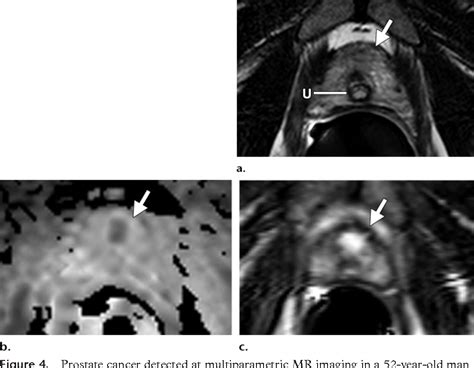 Figure 1 From Imaging Guided Prostate Biopsy Conventional And Emerging Techniques Semantic