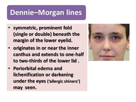 Dennie Morgan Lines Treatment - Pregnant Health Tips