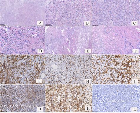 Pathological Features And Immunophenotypes Of Borderline Solitary