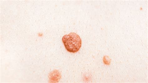 Difference Between Genital Warts And Skin Tags