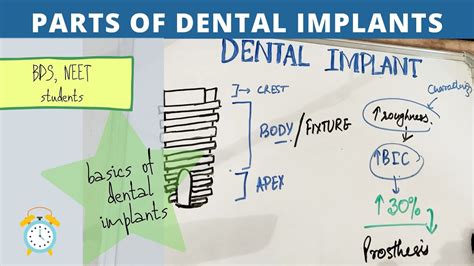 Basics Of Dental Implants Parts Of Implant Youtube