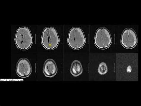 Mri Brain Subdural Hematoma S In Supra And Infratentorial Compartment S