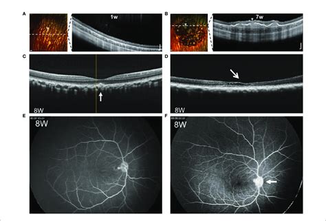 Comparative Images Of Rpe Grafts With And Without Rejection A B