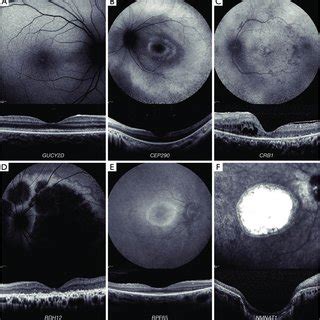 Retinal Imaging Of Rod Cone Dystrophies A Autosomal Dominant