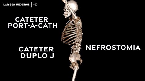 DUPLO J NEFROSTOMIA E PORT A CATH Exemplo De Uso De Stents E