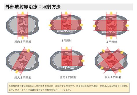 放射線治療は“がん治療の三本柱”の1つ｜放射線アカデミア