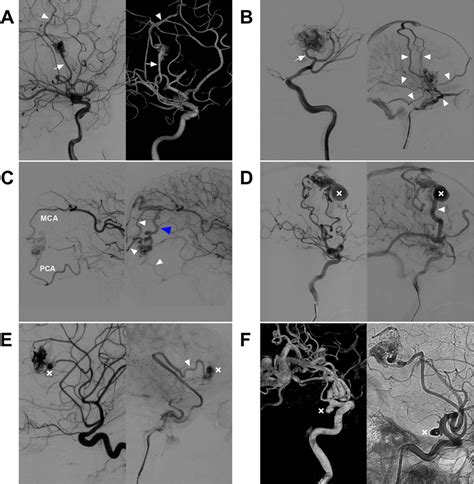 Angiographic Characteristics Of MCA BAVMs A Two Dimensional Angiogram