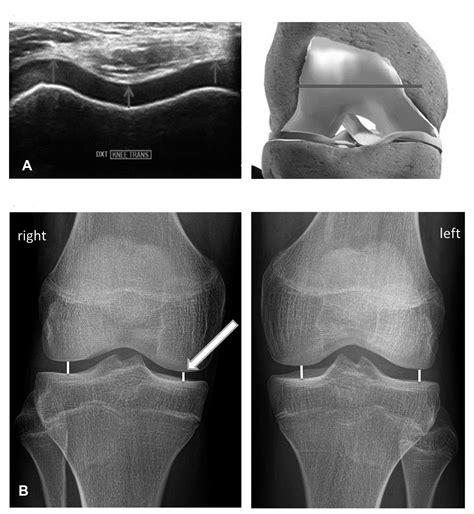 Knee Joint Space