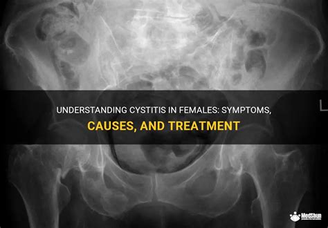 Understanding Cystitis In Females Symptoms Causes And Treatment