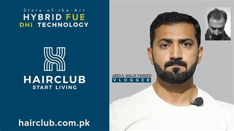 Hair Transplant Famous Vlogger Abdul Malik Fareed Hybrid Fue Hair