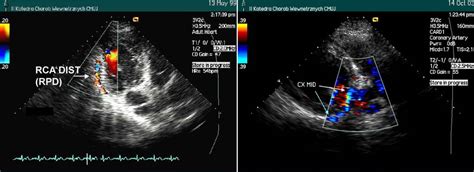 A Ecocardiografia Em Casos Especiais Parte 1 Blog Ecope