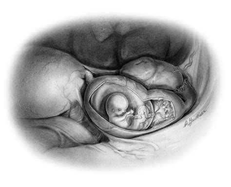 Ectopic tubal pregnancy — Andrea Gauthier
