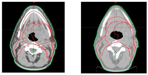 Jpm Free Full Text Adaptive Radiotherapy In Head And Neck Cancer