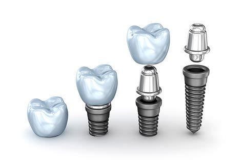 Implantes dentales para personas con problemas de hueso Clínica