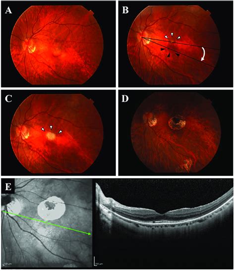 Representative Eye Before And After Limited Macular Translocation