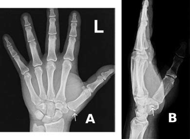 Radiolucent foreign body was detected on simple X-rays. (A ...