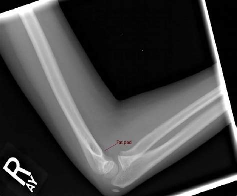 Imagelateral X Ray Of The Elbow Merck Manual Professional Edition