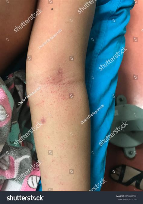 Petechiae Petechiae Tiny Purple Red Brown ภาพสต็อก 1158093562