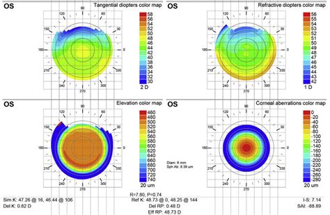 Postoperative Day 12 Corneal Topography Download Scientific Diagram