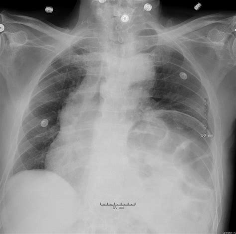 Recurrent Syncope While Eating An Unusual Presentation Of A Diaphragmatic Hernia Bmj Case Reports