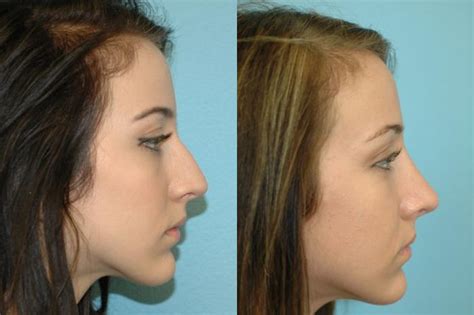 Nose Surgery Before And After Photos Patient 98 San Francisco Ca Kaiser Permanente Cosmetic