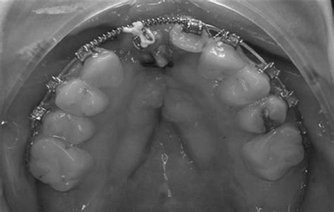 Patient No 1 Orthodontic Preparation After Bilateral Secondary