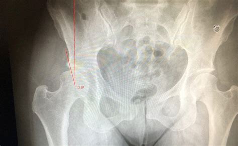 Peri Acetabular Osteotomy » Fresno Orthopedist - Orthopedic Surgery ...