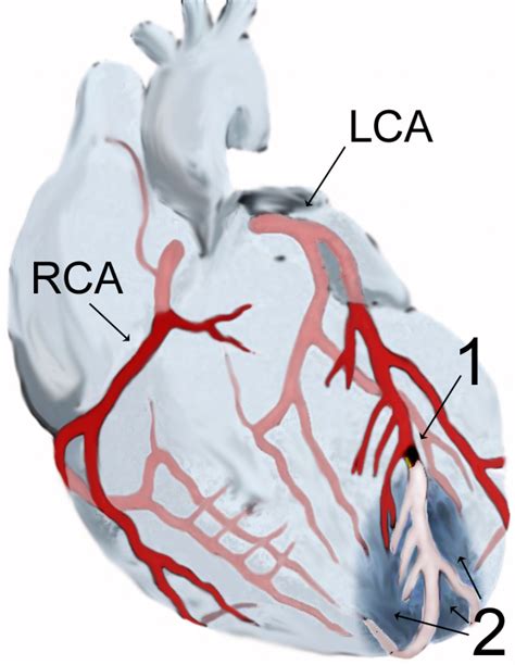 Diseases And Disorders Of The Heart Boundless Anatomy And Physiology