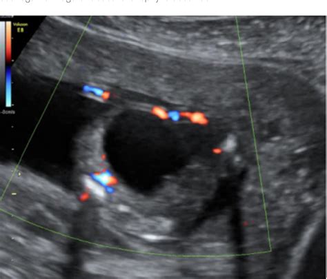 Figure From Cloacal Exstrophy A Rare Fetal Malformation With