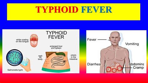 Typhoid Fever: Salmonella Typhi, 47% OFF