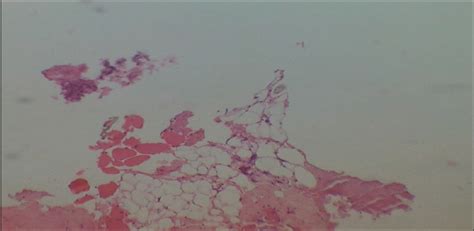 A Rare Case Of Mediastinal Nonseminomatous Germ Cell Tumor W